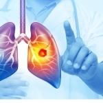 her-yil-25-bin-akciger-kanseri-vakasi-onlenebilir.jpg