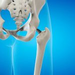 kalça protezi ameliyatı (1)