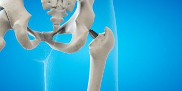 kalça protezi ameliyatı (1)