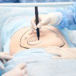liposuction (4)